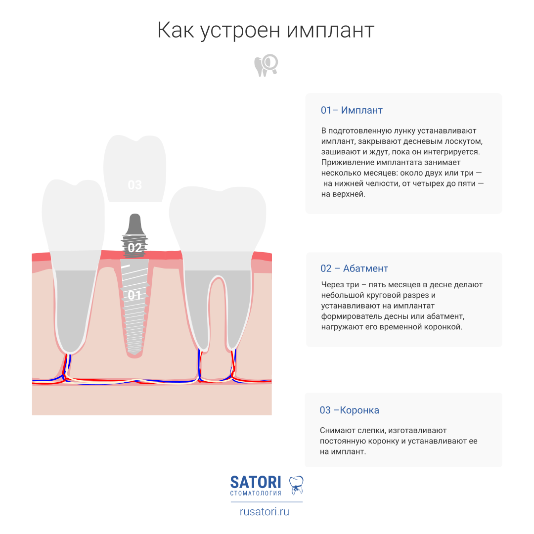 Зубы импланты поэтапно. Схема установки стоматологических имплантов. Импланты схема установки. Импланты схема установки имплантация. Implant схема установки.