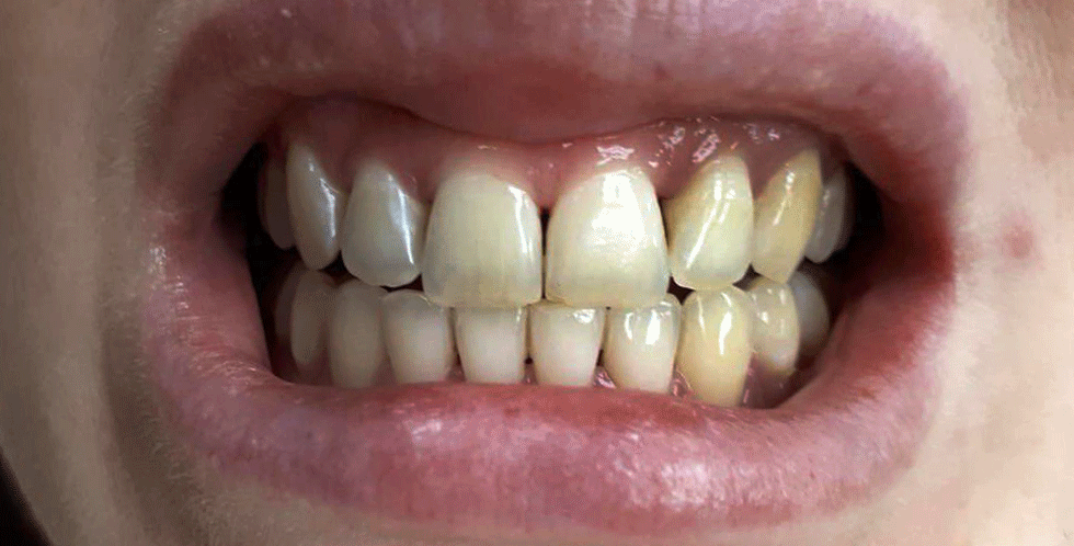 Профессиональная чистка зубов - до и после