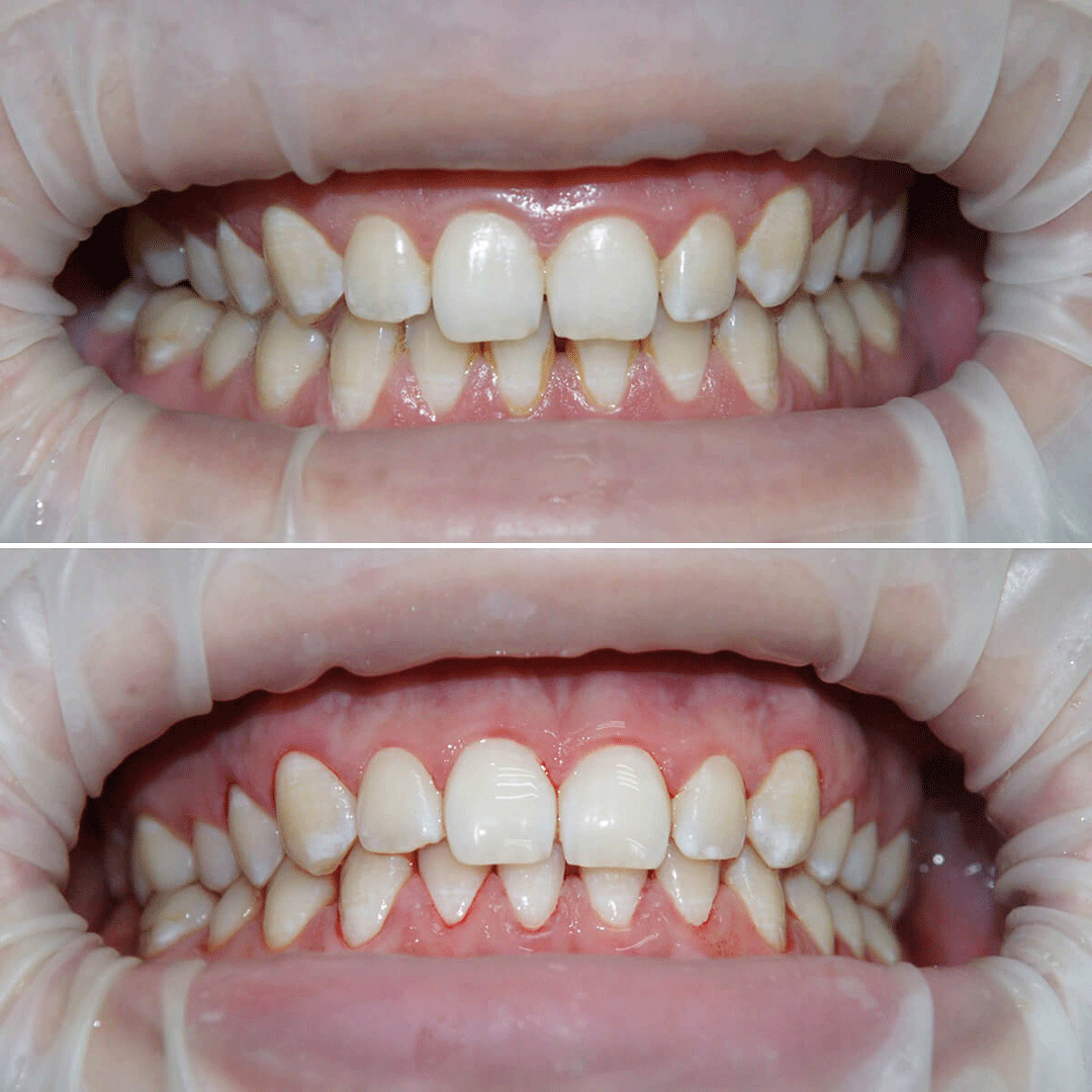 Профессиональная чистка зубов - до и после